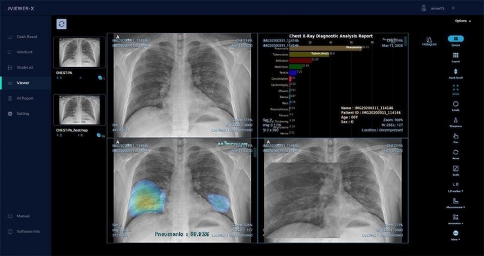 제이엘케이인스펙션 인공지능 흉부 X-Ray 솔루션